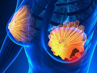 Breast disorders000 e1791960977542